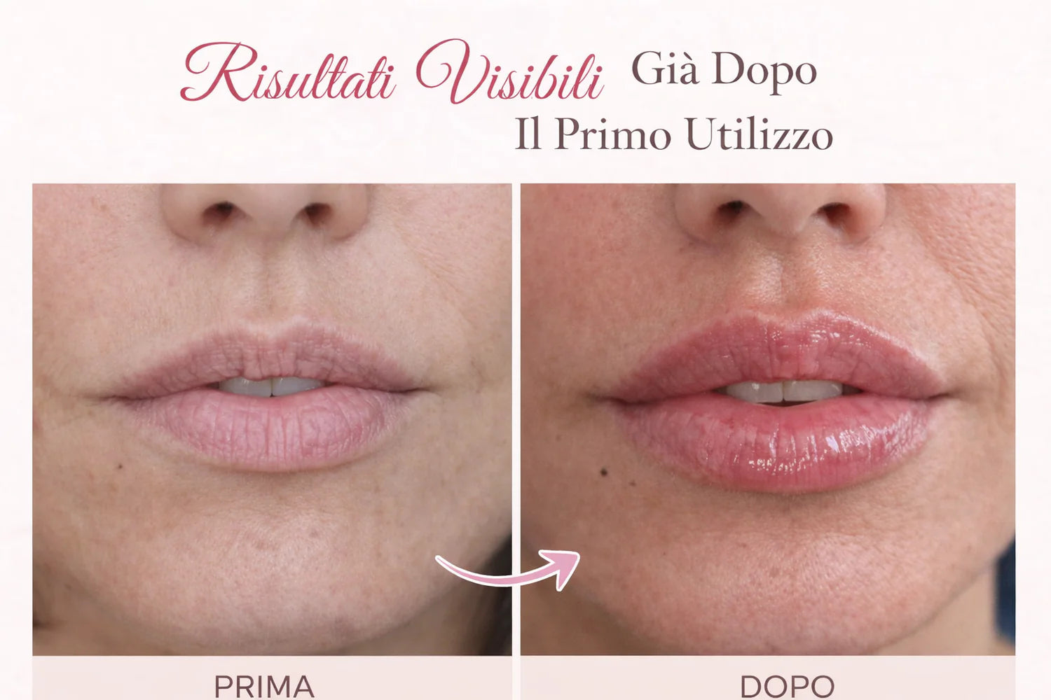 Derma Roller · Labbra Rimpolpate Senza Iniezioni